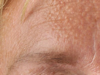 Idiopathic facial papules