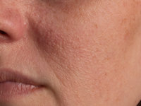 Idiopathic facial papules