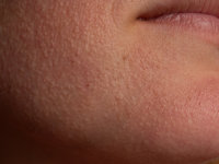 Idiopathic facial papules