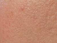 Idiopathic facial papules