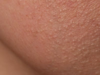 Idiopathic facial papules