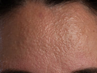 facial papules in frontal fibrosing alopecia