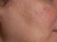facial papules in frontal fibrosing alopecia