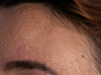 facial papules in frontal fibrosing alopecia