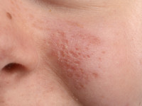 Facial pitting scars