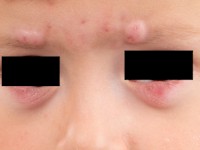 Facial aseptic granuloma