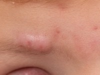 Facial aseptic granuloma