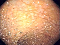 Gardner syndroom, familial adenomatous polyposis