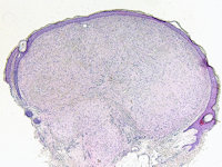 PA discoid fibroma