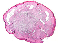 PA discoid fibroma