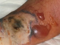 Necrotiserende fasciitis