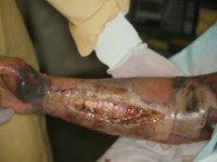 Necrotiserende fasciitis