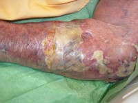 necrotiserende fasciitis