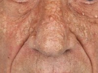 Favre-Racouchot syndrome