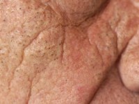 Favre-Racouchot syndrome