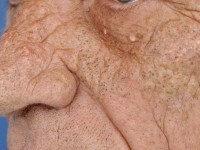 Favre-Racouchot syndrome