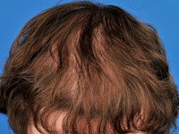 Androgenetic alopecia, female pattern hair loss