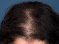 Androgenetic alopecia, female pattern hair loss