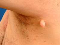 Fibroma molle, skin tag, acrochordon