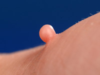 Fibroma molle, skin tag, acrochordon