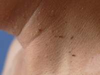 Fibroma molle, skin tag, acrochordon