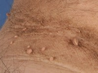 Fibroma molle, skin tag, acrochordon