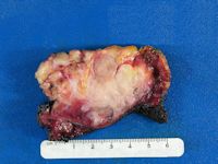 Plantaire fibromatosis