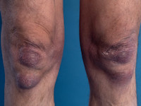 Fibrous nodules bij acrodermatitis chronica atrophicans