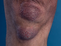 Fibrous nodules bij acrodermatitis chronica atrophicans