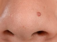 fibrous papule of the nose