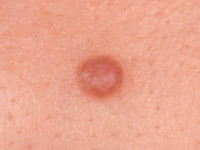 fibrous papule of the nose