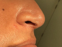 fibrous papule of the nose