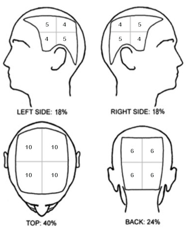 SALT score bij alopecia areata