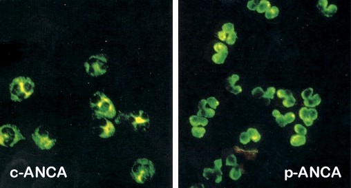 ANCA'S (Anti-neutrofiele cytoplasmatische antistoffen)