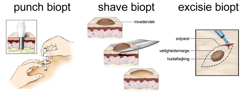 Skin biopsy