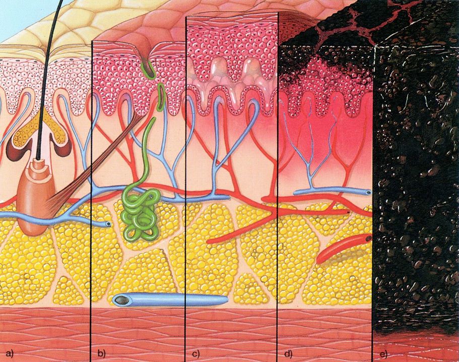 Indeling brandwonden in graden