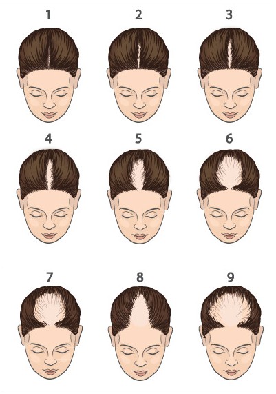 Grade schaal voor alopecia androgenetica bij vrouwen