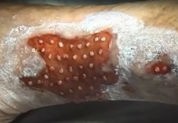 Video van punchgraft huidtransplantatie