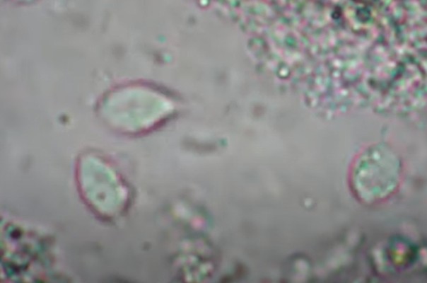 Trichomonas vaginalis, trichomoniasis