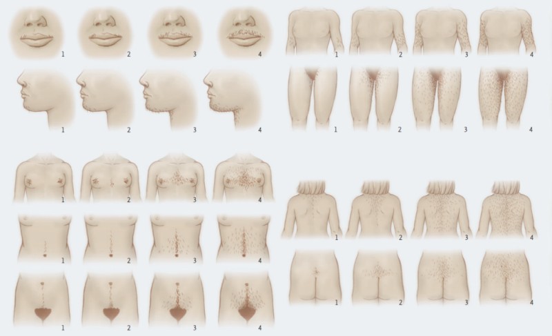 Ferriman-Gallwey Scoring System for Hirsutism