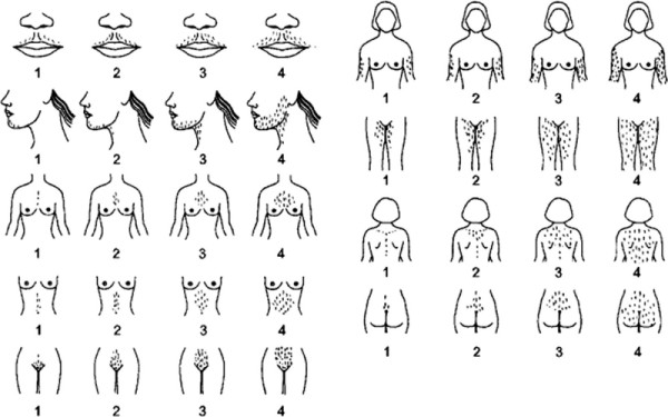Hirsutism scorecard