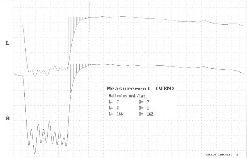 Licht reflex rheografie (LRR)