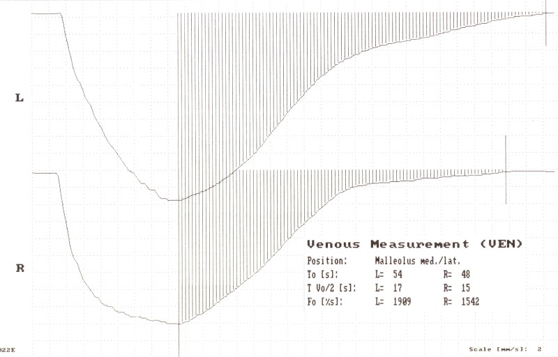 Licht reflex rheografie (LRR)