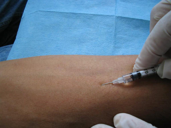 Mantoux
