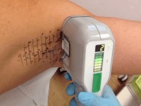 MiraDry bij hyperhidrosis axillaris