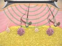 MiraDry bij hyperhidrosis axillaris