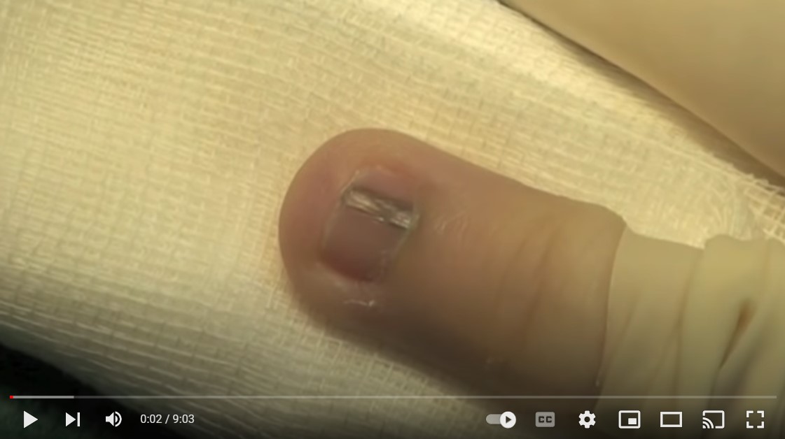 Nagel matrix biopt afnemen