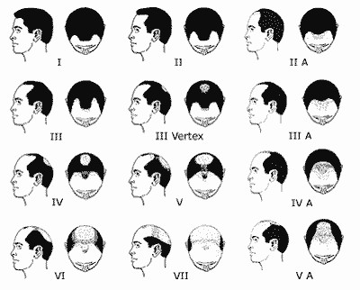 Norwood schaal voor alopecia androgenetica bij mannen