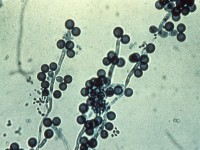 Fungal threads and yeast balls (Candida albicans)