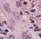 Leukocytoclastische vasculitis